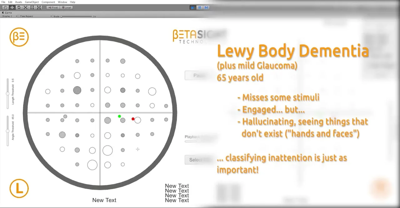 A frame from the Eye Tracking Personalities video: the BetaSight visual-field test, with gaze points plotted across a circular field and a case readout alongside.